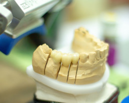photo of tooth replacement